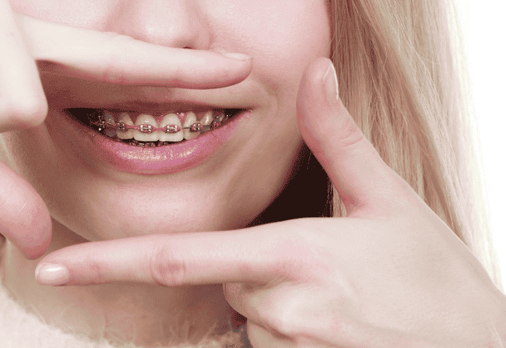 girl wearing braces